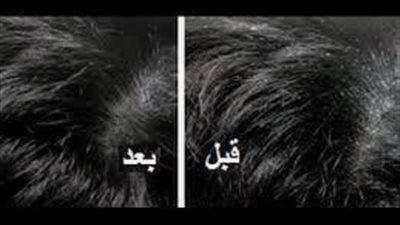 كيف تتخلص من قشرة شعر الرأس؟