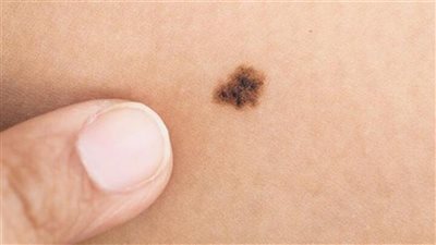 علامات تحذرك بأن «الحسنة ـ الشامة» قد تكون مؤشرًا للإصابة بالسرطان إليك ما يخفى عنك