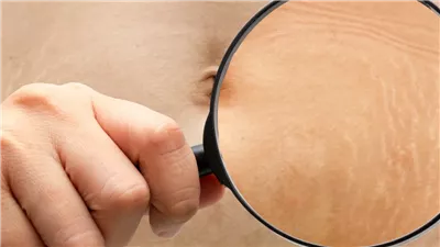 التحذير للنساء فقط السبب يخوف اعرفي سر ظهور التشققات الجلدية في الشتاء