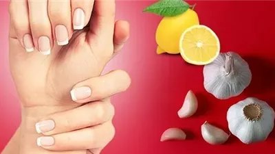 5 علامات تظهر على الأظافر تدل على الإصابة بالكبد الدهني منها خطوط الأظافر