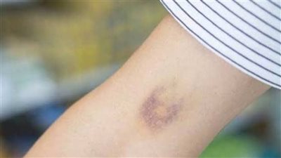 عند ظهور بقع زرقاء بهذا الشكل عليك الذهاب للطبيب فورا فالأمر خطير