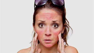 بدون الذهاب الي الطبيب اسرع طرق طبيعية لعلاج حروق الشمس خلال موجة الحر الحارقة 