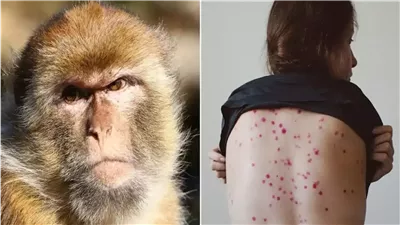 قبل ايام من بدء الدراسه إزاي تحمي اولادك من جدري القرود وماهى طرق الوقاية