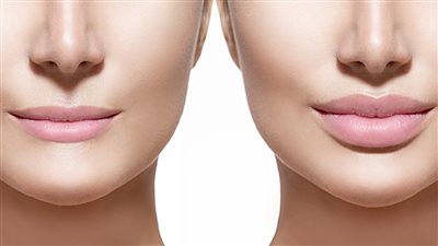 الإفراط في استخدام الفلير يؤدي لنتائج غير طبيعية... تحذير خطير من الأطباء ويطالبون بعد حقن تلك المنطقة نهائيا