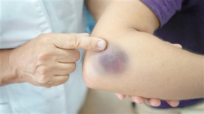 ظهور علامات زرقاء على الجلد أمر غير طبيعي...تحذيره من ظهور خمس كدمات في آن واحد على الجسم وعليك الذهاب للطبيب فورا