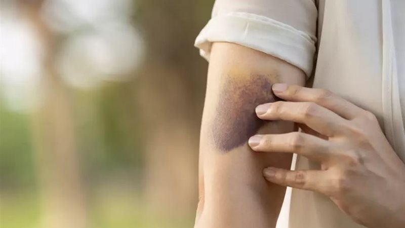 ظهور الكدمات الزرقاء