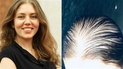 بعد الصلع.. رحمة حسن مُصابة في يدها وعلقت قائلة: “الحمدلله دائماً وأبداً ”