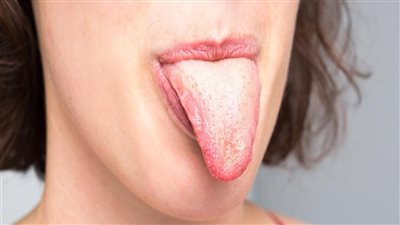 8 حلول طبيعيه لعلاج فطريات اللسان والفم.. وداعًا لتقرحات الفم