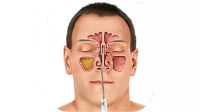 طرق علاج الجيوب الأنفية والوقاية من الالتهابات والحساسية