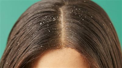 أسباب ظهور قشرة الشعر 