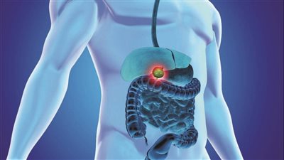 هل سمعت عن لحمية المرارة من قبل تعرف على الأسباب وطرق العلاج