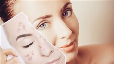 تعاني من حبوب الوجه إليكي هذه الوصفات الطبيعية للتخلص منها