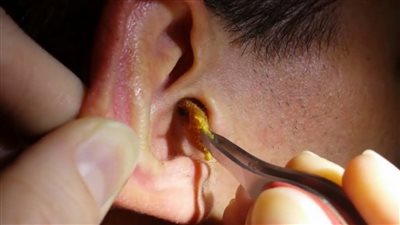 اعرف ازاي تتخلص من الشمع الزائد في أذنك بطريقة صحية بدلا من الذهاب للطبيب