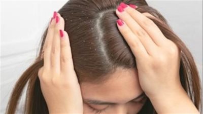 تخلصي من مشكلة قشرة الشعر باستخدام هذه الوصفات الطبيعية