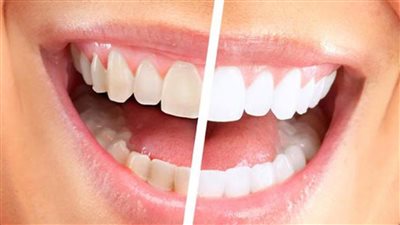علاجات طبيعية في المنزل لإزالة الجير من على أسنانك