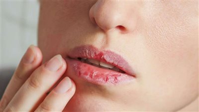 وداعا لتشقق الشفاه اعرفي ازاي تحافظي علي الشفاه في فصل الصيف