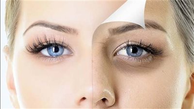 مافيش هالات سوداء من النهاردة إزاى تتخلصى منها فى 3 خطوات سهلة وبسيطة ومش مكلفة