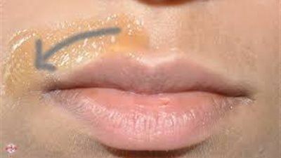 وصفه سحرية للتخلص من شعر الشفة نهائيًا وبسرعه وبدون آلام