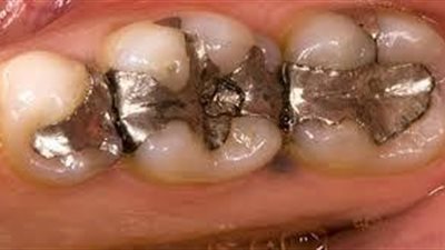 لهذا يجب أن تنزعوا حشوة أسنانكم وأسنان أولادكم تماماً وفوراً !