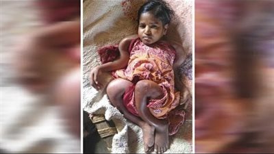 انكماش اطراف فتاة هندية نتيجة اصابتها بمرض نادر وأهل قريتها يجمعون لها المال من أجل علاجها