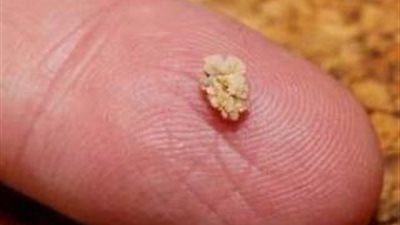 ادخل شوف الحل اذا كنت تعاني من وجود حصوة في الكلى