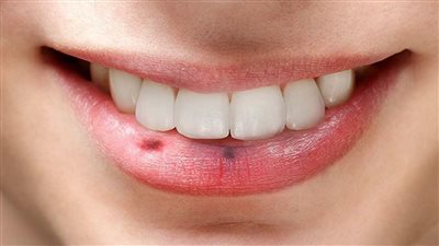 منها الهرمونات والعصبية ما لا تعرفه عن هربس الشفاه