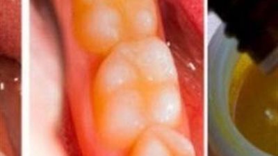 وصفة سحرية لعلاج جير الأسنان في اقل من دقيقة