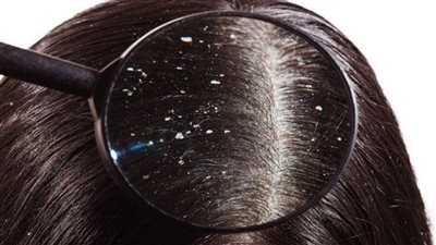 لا شامبوهات ولا علاج اتخلص من قشرة الرأس بهذه الحيل