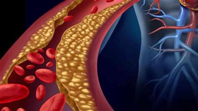 الكوليسترول عالي عندك الموضوع مش محتاج دكتور 8 معلومات لو عرفتنهم هتقلل النسبة وتحافظ على قلبك