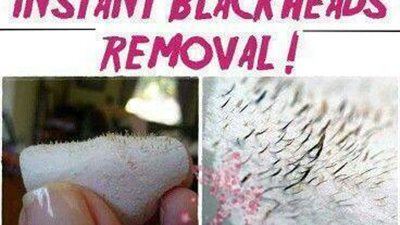 لو كنتي بتعاني من البثور السوداء معانا هتلاقي الحل