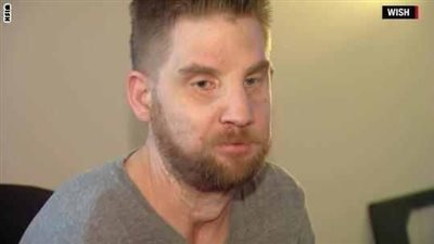 بعد إصابته بحادث سيارة رجل يتعرض لأول عملية زراعة وجه في العالم