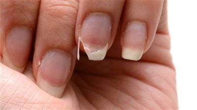 مش هنغرمك فلوس لو عندك مشكلة في أظافرك وبتتكسر هنقولك تحلي المشكلة إزاي