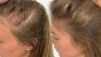 4 مكونات من مطبخك تسد فراغات شعرك وتجعله كثيف خلال مدة قصيرة