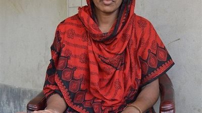 بالصورة ..امرأة تعاني من تورم يدها بشكل كبير وحيرت الاطباء في علاجها