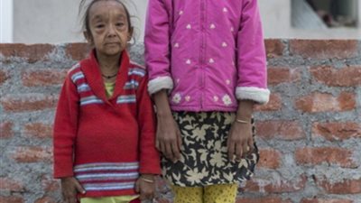 بالصور ..طفلين بـ عمر الزهور يتحولان إلى كبار في السن