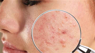 تخلصي من حب الشباب بطرق سهله وبسيطه خليكى منورة