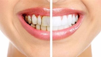 وصفة سحريه لازالة جير الاسنان ورواسب الفطريات والبكتيريا