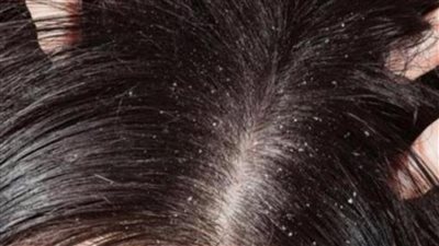 وصفات طبيعية لحل مشاكل الشعر المختلفه نهائيا فى 7 ايام