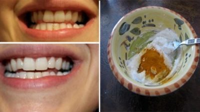 بثلاث مكونات طبيعية موجودة في كل بيت يتم ازالة الجير نهائيا من الاسنان ويعالج الامها