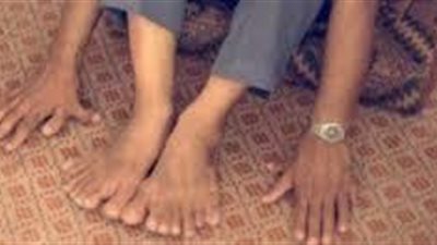بالصور رجل هندي لدية 28 اصبع