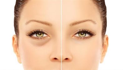 لازاله الانتفاخ من العينين عليكي بهذه الطريقه