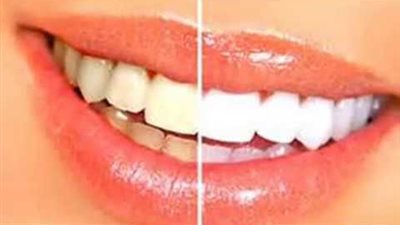 لازالة اصفرار الاسنان والجير