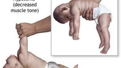 الاطفال اللي اقل من سنة ممنوع نأكلهم عسل نهائي لهذة الخطورة