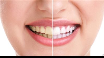 خمسة طرق طبيعية لتبييض الأسنان فى المنزله بسرعه و سهوله