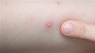 طرق الوقاية والأعراض خطوات بسيطة لتجنب الإصابة بـ جدري القرود