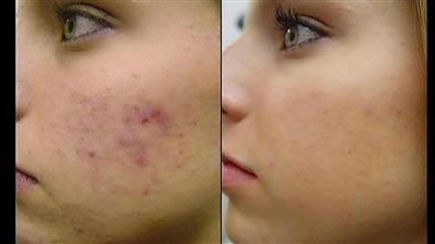 أسرع طرق علاج للتخلص من حبوب الوجه من المنزل جربيهم ووشك هينور
