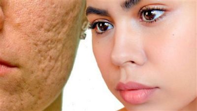 انجح وصفات طبيعية للتخلص من حفر الوجه و لإزالة الكلف والبقع الداكنة