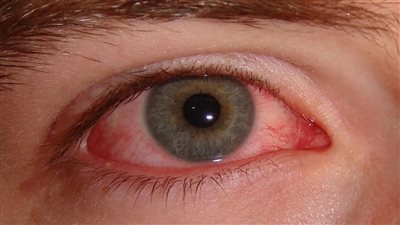 حساسية العين متى تحدث ومن هم الاكثر عرضة للاصابة بها