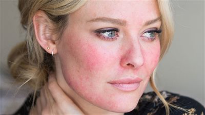 للتخلص من البقع الحمراء تعرفي على هذة الوصفات الطبيعية لبشرة صافية