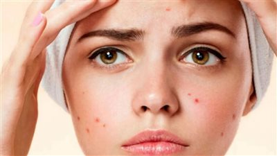 اذا تعانى من زيادة حب الشباب فى الصيف فتعرفى على اسبابة وطرق الوقاية منة